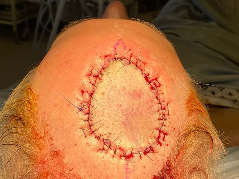 Skin Cancer Treatment