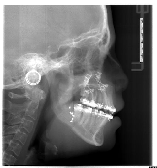 Lateral Cephalogram post-op.