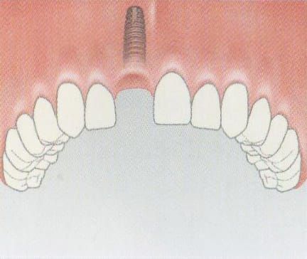 The implant is inserted into the jawbone without affecting adjacent teeth