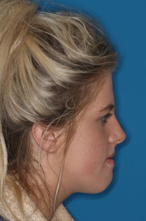 Profile pre-op.