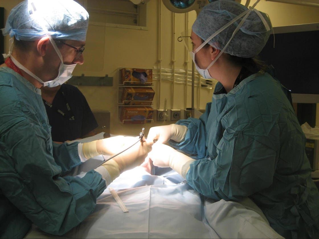 Stone removal from left parotid duct