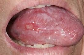 Oral lichen planus - erosive type appearing as a tongue ulcer