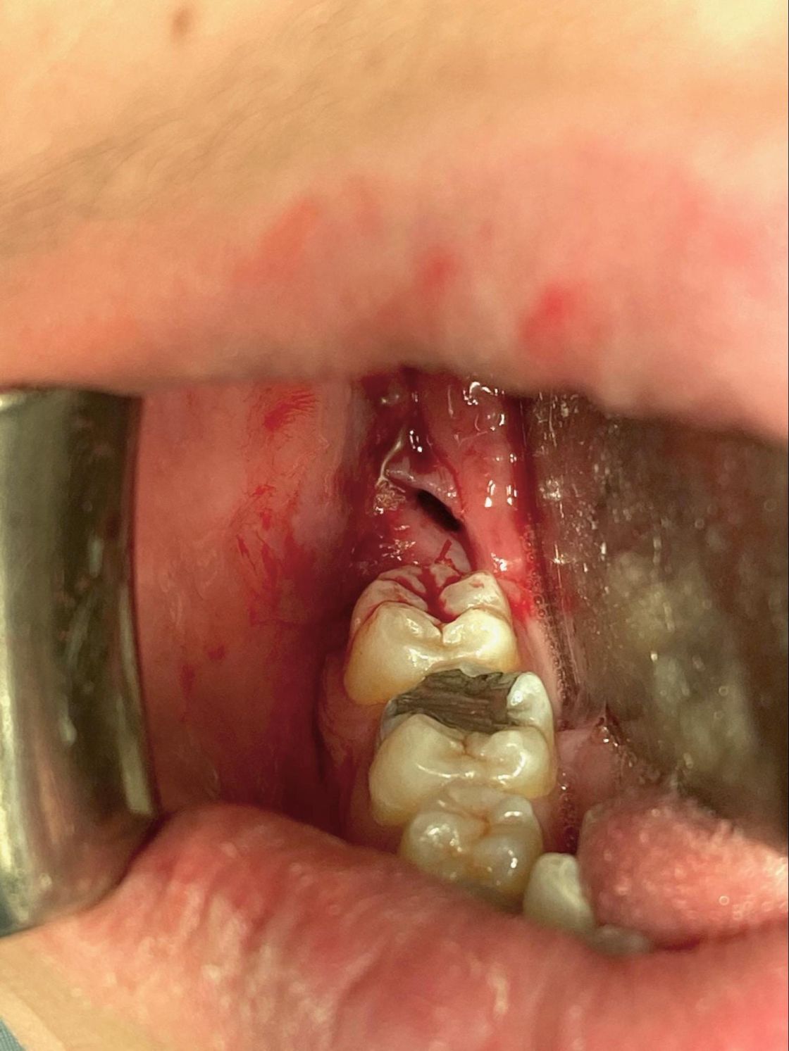 Dento-alveolar Surgery | Miles Duncan