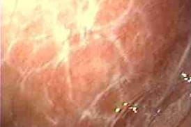 Oral lichen planus - reticular type appears as white patch in the cheek