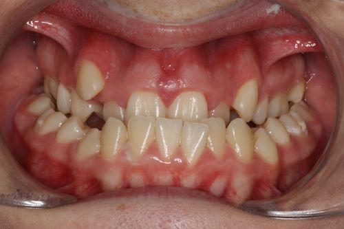 Frontal pre-op.