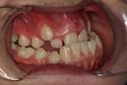 Right lateral pre-op.