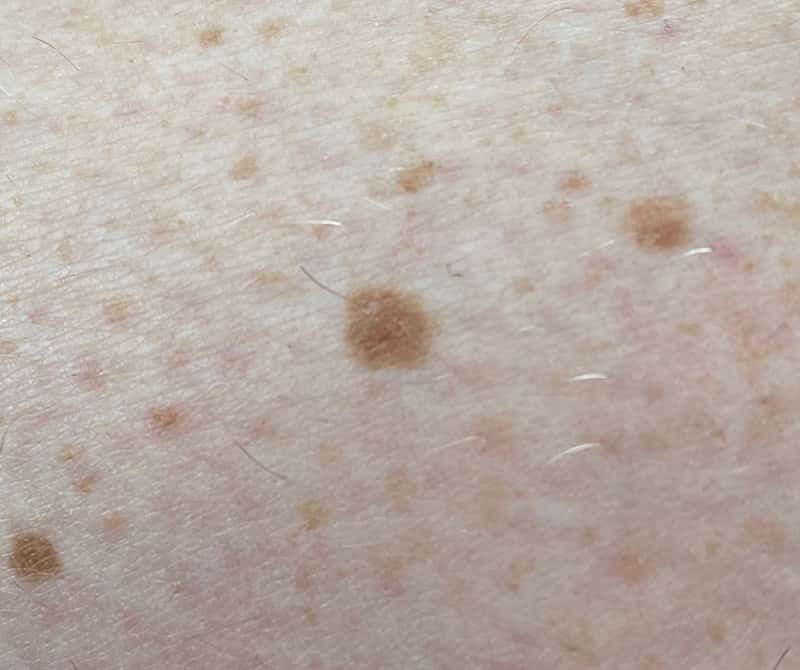 Simple Facial Skin Problems / Lesions