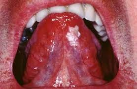 White patches under the tongue - 'sublingual keratoses' have an increased risk of cancerous change