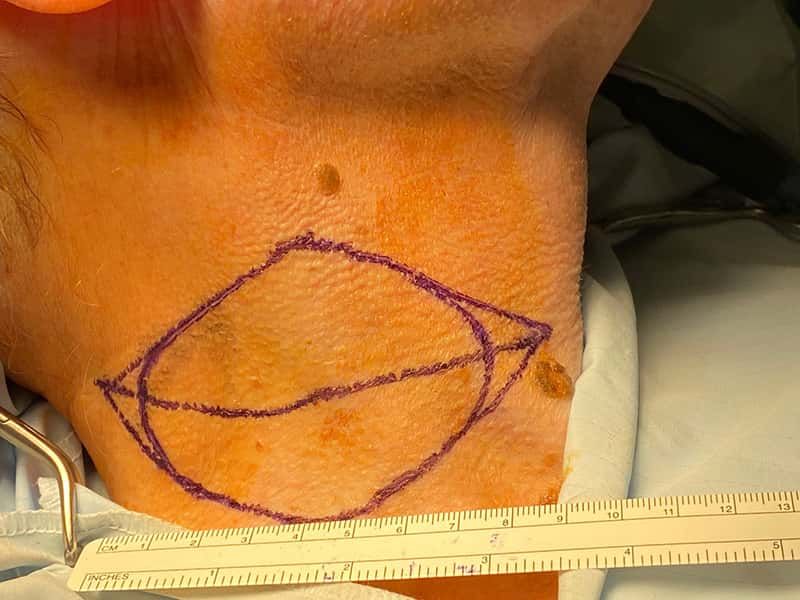 Skin Cancer Treatment