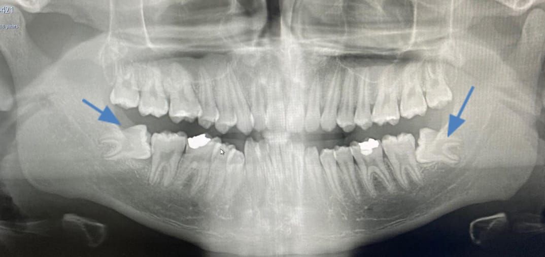 Blue arrows showing both lower wisdom teeth which are impacted forwards (mesially).