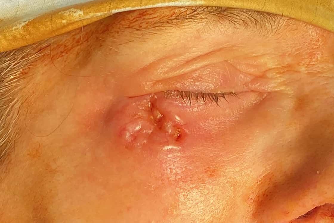 Large BCC right lower eyelid requiring full thickness reconstruction of lower lid with local flap and mucosal graft from mouth lining