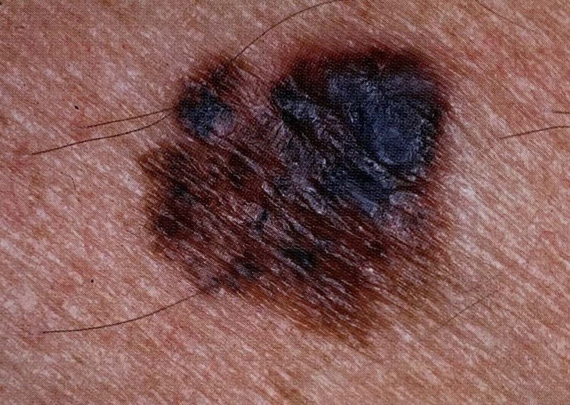 Skin Cancer Treatment