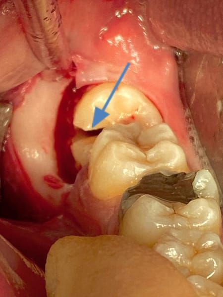 Wisdom tooth is cut in half  - arrow - (vertically or horizontally depending on the root shape/divergence – in this case vertically) and the roots removed separately.