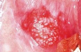 Speckled red and white patches - 'speckled leukoplakia' has an increased risk of changing into an oral cancer