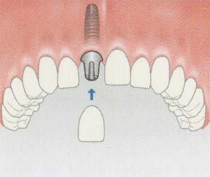 The abutment is attached to the implant before the crown can be cemented/screwed into place