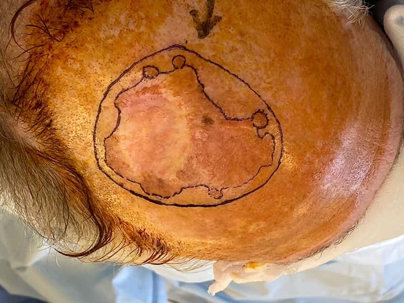 Skin Cancer Treatment