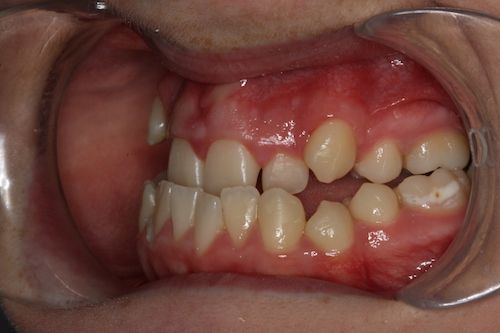 Left lateral pre-op.