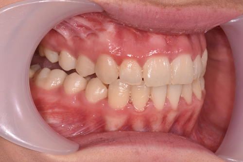 Right lateral post-op.