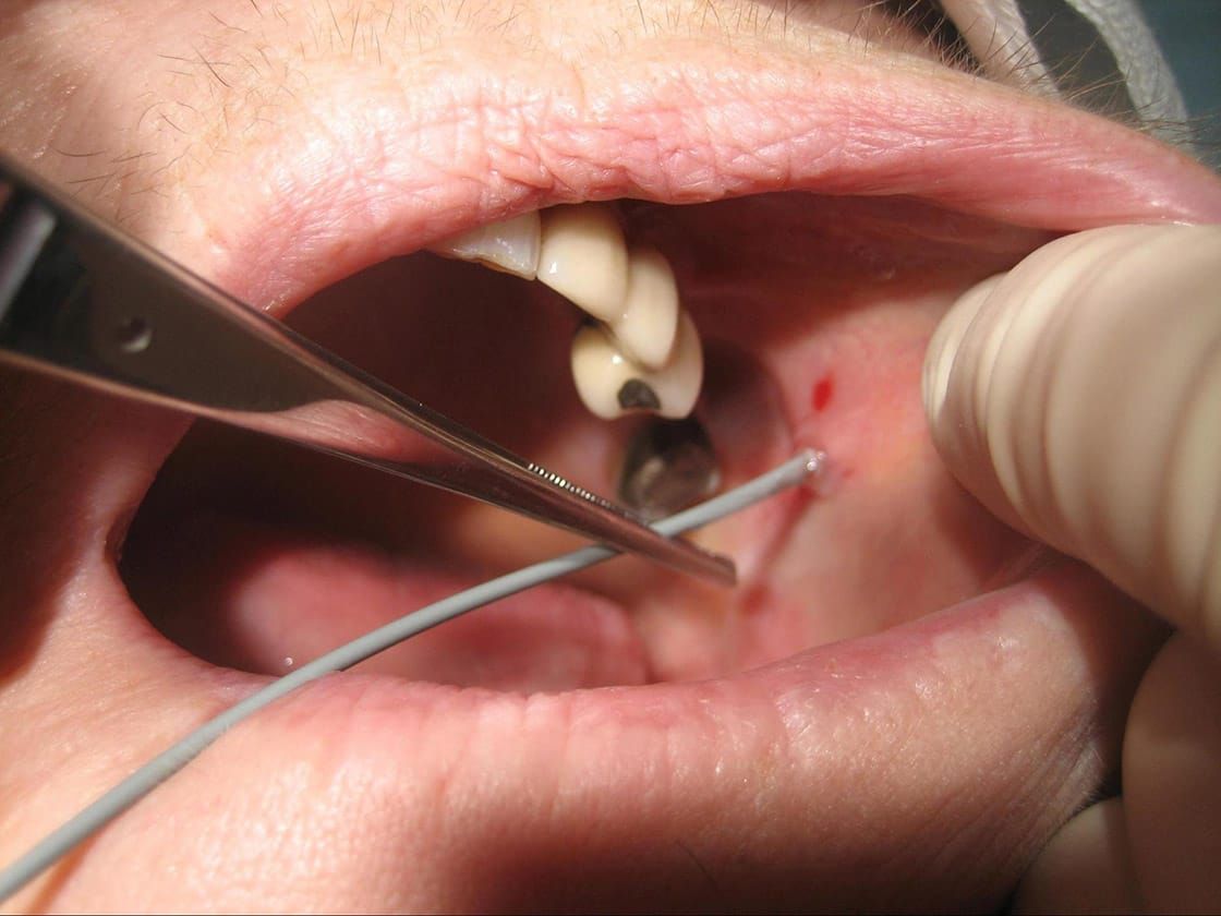 Dilating left parotid duct in order to allow safe passage of sialendoscope