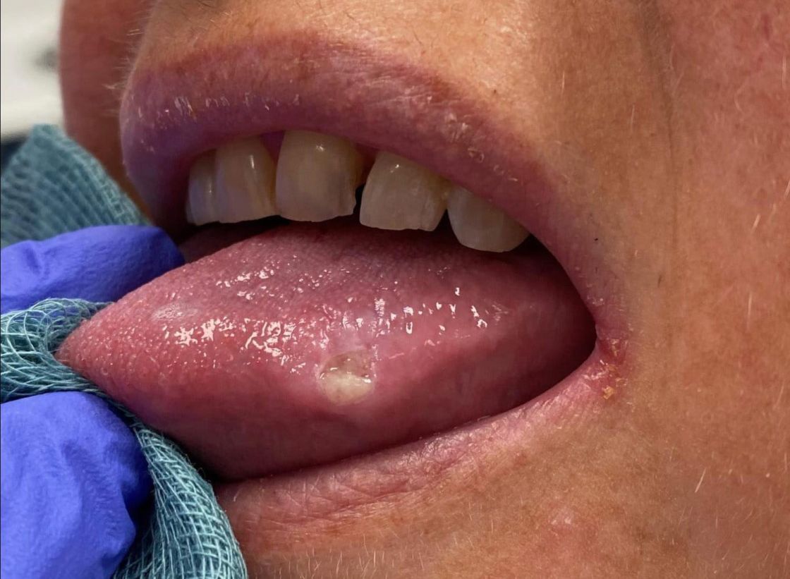 Healing tongue ulcer from trauma – tongue biting