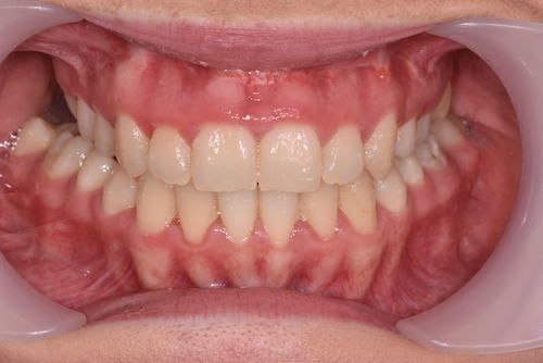 Frontal post-op.