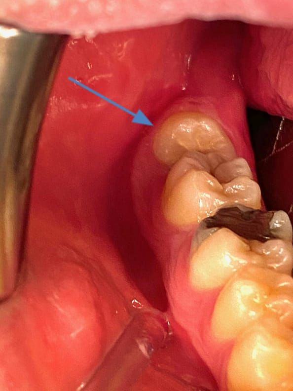 Impacted lower right wisdom tooth (partially erupted – blue arrow)