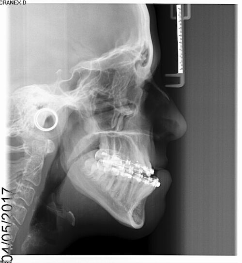 Lateral Cephalogram pre-op.