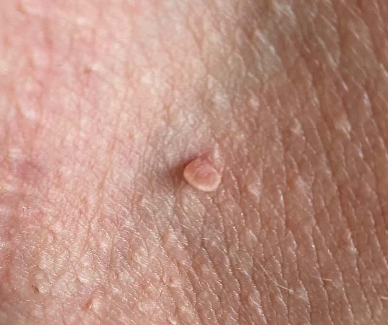 Simple Facial Skin Problems / Lesions