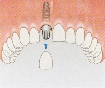 Replacing a single tooth - avoiding the need to grind down adjacent teeth as for conventional crowns and bridges