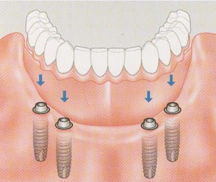 Multiple Implants can be used to anchor dentures so they are more fixed in your mouth and less likely to cause rubbing and soreness
