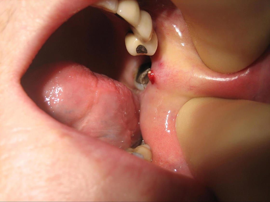 Salivary stone seen emerging from duct after retrieval