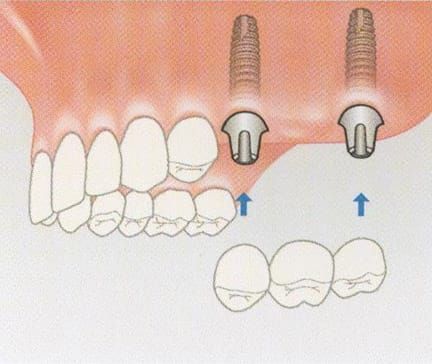 Multiple implants can be used to provide support for a bridge especially on back teeth which require greater loading due to grinding forces