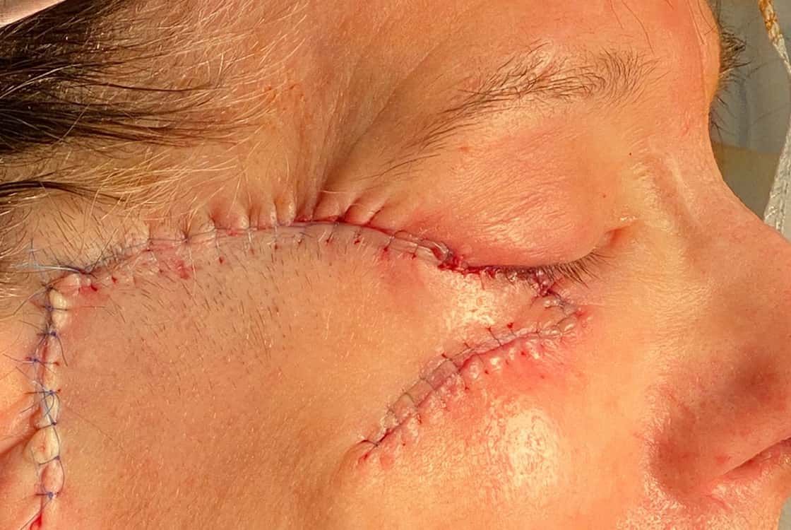 Skin Cancer Treatment