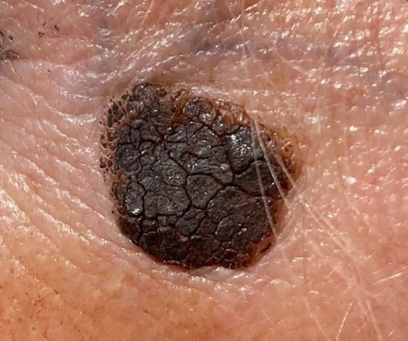 Simple Facial Skin Problems / Lesions