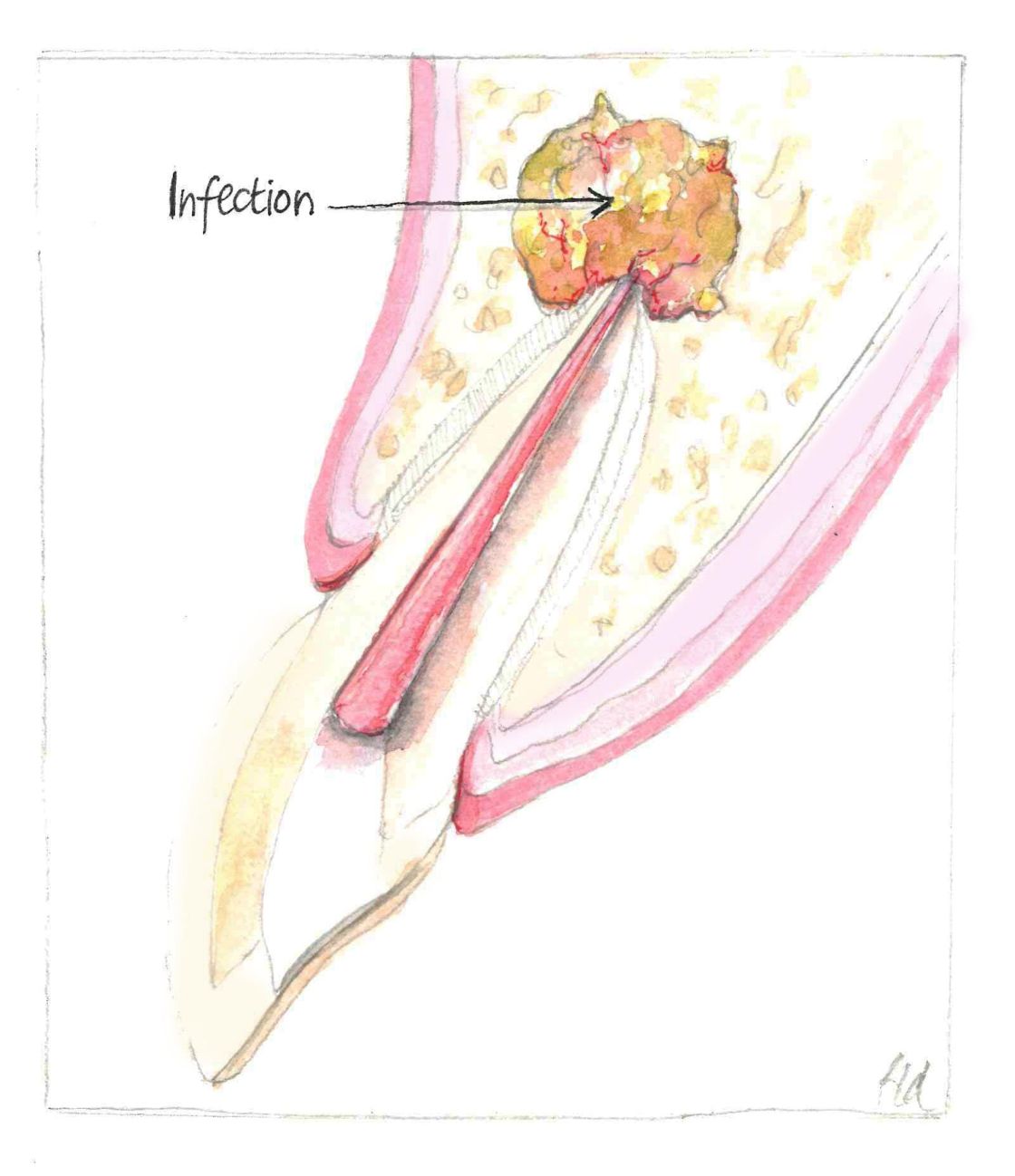 Figure 2 – Infection persisting at root apex after repeated root canal treatment