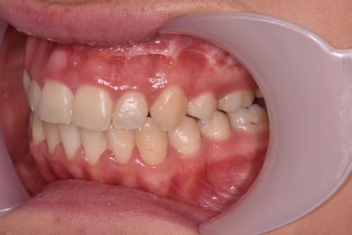 Left lateral post-op.
