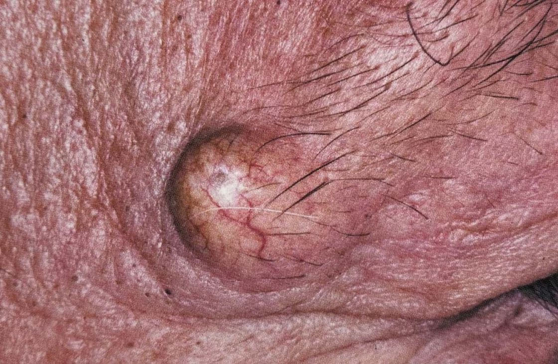 Simple Facial Skin Problems / Lesions