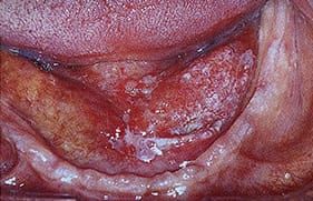 Floor of mouth cancer