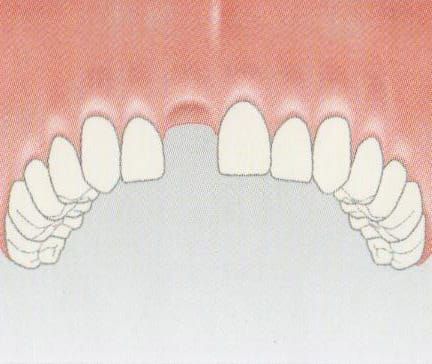 A single missing front tooth can easily be replaced with an implant