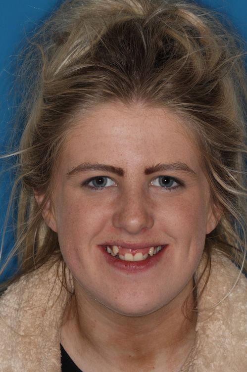 Frontal pre-op.