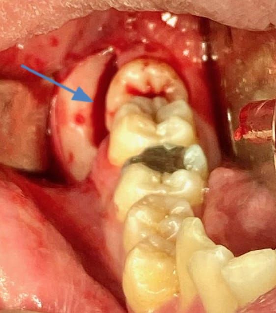Bone removed only on cheek side of tooth with a bur (arrow)