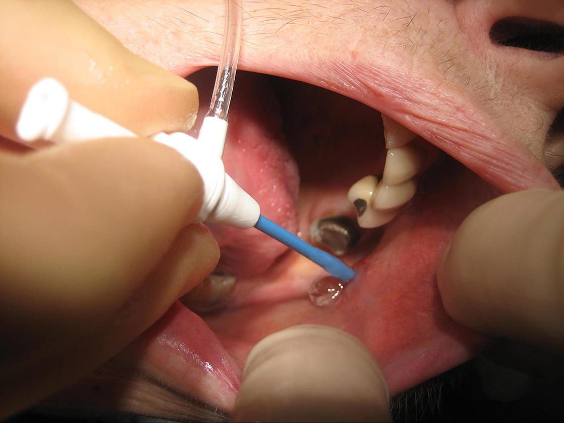 Cannulating the parotid duct ready for scope insertion